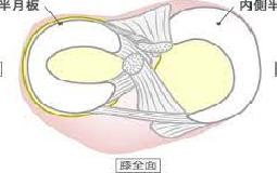 膝の内側が痛い（内側半月板損傷）