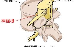 手が痺れる（頸椎神経根症状）