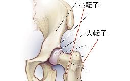 股関節がパキパキ音がする（弾発股）