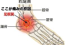 捻挫は治ったはずなのに足首が痛い…足首のセンサーのバグ「足根洞症候群」とは？